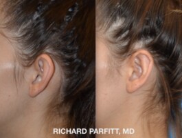 Procedure: Otoplasty (Ear Surgery) Otoplasty-ear-surgery-Middleton-WI-Richard-Parfitt-close up ear