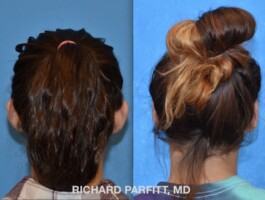 <strong>Procedure: </strong>Otoplasty Otoplasty-ear-surgery-Middleton-WI-Richard-Parfitt-back view ear reconstruction