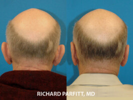 Male Otoplasty patient, back view. Ear pinning by Dr. Richard Parfitt Madison WI otoplasty WI male ear pinning before and after Richard Parfitt, MD