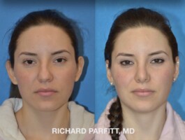 Procedure Performed: Otoplasty (Ear Surgery) Otoplasty-ear-surgery-Middleton-WI-Richard-Parfitt