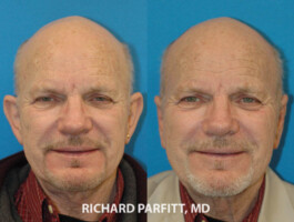 Male Otoplasty patient. Ear pinning by Dr. Richard Parfitt Madison WI otoplasty Appleton WI male ear pinning before and after Richard Parfitt, MD