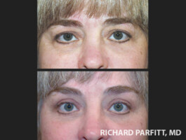 <strong>Procedures:</strong>Forehead Lift, Upper & Lower Blepharoplasty (eye lids) Before and After photo of Brow lift and Upper and Lower Blepharoplasty by Dr. Parfitt