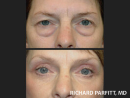 Procedures: Forehead Lift, Blepharoplasty (Eyelid Surgery) Wisconsin brow lift eyelid procedure before and after