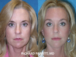 <strong>Procedures: </strong> Facelift/Neck Lift, Forehead/Brow Lift Facelift and Forehead Lift by Dr. Parfitt, Appleton WI