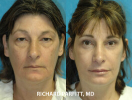 Procedures: Forehead Lift, Facelift, Blepharoplasty (Eyelid Surgery) Minneapolis MN cosmetic surgery forehead lift female