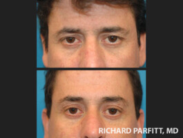 Procedures: Forehead Lift, Facelift, Blepharoplasty (Eyelid Surgery) Appleton WI cosmetic surgery forehead lift male