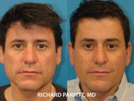 <strong>Procedures: </strong> Forehead/Brow Lift Male Plastic Surgery -forehead lift