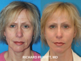 <strong>Procedures: </strong> Forehead/Brow Lift, Upper & Lower Blepharoplasty (eyelids), Facelift Full face rejuvenation with Facelift, Brow lift and Blepharoplasty - Madison WI, Dr. Parfitt
