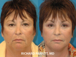 Procedures: Forehead Lift, Blepharoplasty (Eyelid Surgery), Facelift plastic surgery brow lift 50 year old before and after female