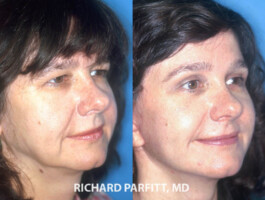 <strong>Procedures: </strong> Forehead/Brow Lift, Upper & Lower Blepharoplasty (eyelids), Facelift Look more awake and happy with a forehead lift and Facelift - Madison, WI Dr. Parfitt