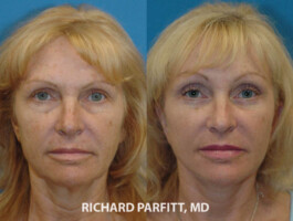 <p>Procedures:</p> Forehead Lift, Facelift cosmetic surgery Milwaukee forehead lift before and after