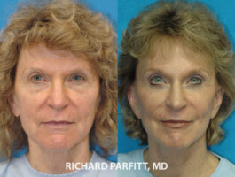 Procedures: Forehead Lift, Facelift cosmetic surgery Green Bay forehead lift female