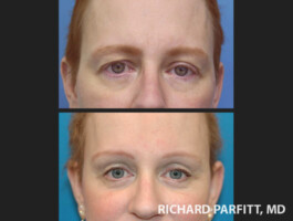 <strong>Procedures: </strong> Forehead/Brow Lift, Upper & Lower Blepharoplasty (eyelids) Raise brows and tighten eyelids to look more refreshed - Madison WI Dr. Parfitt
