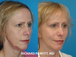 Procedure: Forehead Lift, Facelift Wisconsin brow lift face lift before and after female