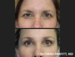 <strong>Procedures: </strong> Forehead/Brow Lift Raise eyebrows with a forehead lift to look more awake - Appleton, WI Dr. Parfitt
