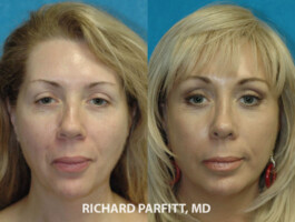 <strong>Procedures: </strong> Forehead/Brow Lift, Upper & Lower Blepharoplasty (eyelids), Facelift Facial Plastic Surgery Appleton WI - Facelift, Blepharoplasty, Forehead Lift