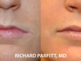 Lip Augmentation before and after - Lip Implants lip augmentation ( Implants )before and after