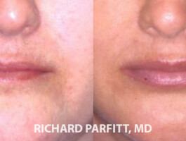 Before and After Lip Augmentation ( upper and lower implant) Before and After Lip implants