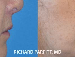 Before and After Upper Lip Lift Before and After Upper Lip Lift