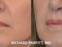 Before and After Upper Lip Lift