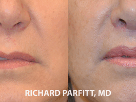 Before and After Upper Lip Lift Upper lip lift