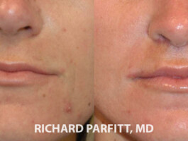 Before and After Upper Lip Lift Lip before and after photos Madison WI