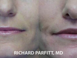 Before and After Upper Lip Lift Dr.Richard Parfitt lip augmentation Madison WI