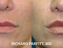 Before and After Upper Lip Lift Madison Wisconsin before and after lip augmentation