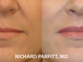 Before and After Upper Lip Lift WI before and after surgery lip augmentation