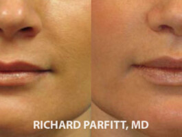 Before and After Upper Lip Lift