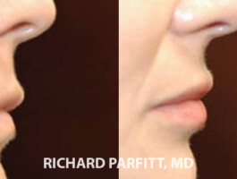 Before and After Upper and Lower Dermal Filler to Lips (non-surgical) Before and After lip filler