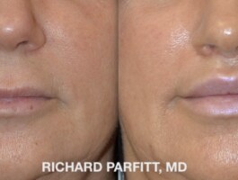 Before and After Upper Lip Lift and Lower Lip Implant Upper Lip Lift and Lower Lip Implant by Dr. Parfitt