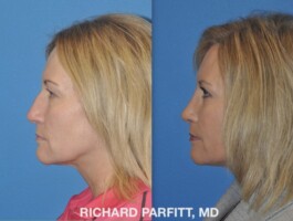 <strong>Procedure: </strong>Rhinoplasty (Nose Job), Upper & Lower Blepharopalsty Before and After Rhinoplasty, Nose Surgery, Upper and Lower Blepharoplasty, eye surgery, plastic surgery by Dr. Parfitt Middleton WI left side view