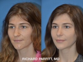 <strong>Procedure: </strong>Rhinoplasty (Nose Job) Young woman Rhinoplasty to make nose look more feminine, right side by Dr. Richard Parfitt