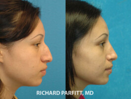 <strong>Procedure: </strong>Rhinoplasty (Nose Job) nose surgery hispanic rhinoplasty Middleton WI by Richard Parfitt