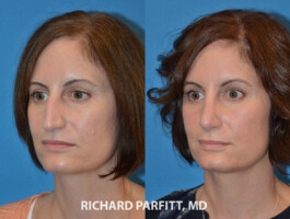Procedure: Rhinoplasty (Nose Job) nose job before and after female Madison WI plastic surgery