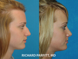 Procedure: Rhinoplasty (Nose Job) nose job before and after 20 year old female Wisconsin plastic surgery