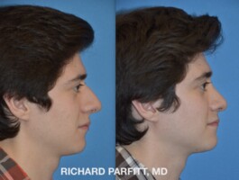<strong>Procedure: </strong>Male Rhinoplasty (Nose Job) Before and After Rhinoplasty, nose surgery, Male Rhinoplasty photos, side view, plastic surgery by Dr. Parfitt Madison WI