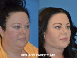 <strong>Procedure: </strong> Submental (Neck) Liposuction, Jowl Liposuction, Buccal Fat Removal Oblique view of neck liposuction, jowl liposuction and Buccal Fat removal female patient before and after picture Dr. Richard Parfitt of Madison WI