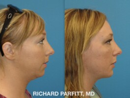 <stong>Procedure:</stong>Submental Liposuction (chin fat removal), Chin Augmentation (implant) Before and After photo of young woman, Submental Liposuction, chin fat removal, and Chin Augmentation, implant, by Dr. Richard Parfitt, Madison WI