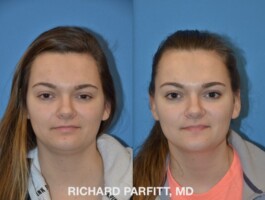 Procedure: Submental Liposuction (chin fat removal) Before and After Submental Liposuction, chin fat removal, by Dr. Richard Parfitt, Madison WI