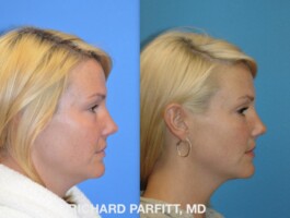 Procedure: Submental Liposuction (chin fat removal) Before and After photo of young woman, Submental Liposuction, chin fat removal, by Dr. Richard Parfitt, Madison WI