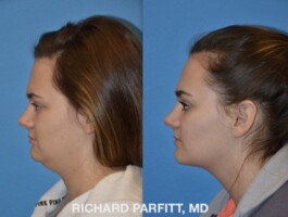 <strong>Procedure:</strong> Submental Liposuction (chin fat removal) Before and After Submental Liposuction, chin fat removal, by Dr. Richard Parfitt, Madison WI, left side view