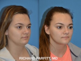 Procedure: Submental Liposuction (chin fat removal) Before and After Submental Liposuction, chin fat removal, by Dr. Richard Parfitt, Madison WI, right oblique view