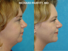<strong>Procedures: </strong> Submental Liposuction and Buccal Fat Removal (cheek fat) Submental Liposuction and Buccal Fat Removal Dr. Parfitt - Appleton and Middleton WI