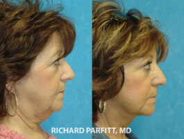 Procedures: Submental (Neck) Liposuction, Facelift neck liposuction female before and after plastic surgery WI