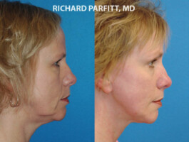 Procedure: Submental (Neck) Liposuction & Facelift Appleton WI cosmetic surgery neck liposuction before and after