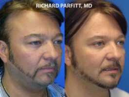 <strong>Procedures: </strong> Chin Augmentationt, Upper Blepharoplasty (eyelids), Submental Liposuction Chin Augmentation, Blepharoplasty and Submental Liposuction, Appleton WI Dr. Parfitt