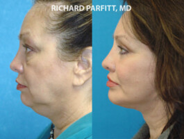 <strong>Procedures: </strong> Facelift with Sub-mental Liposuction, Upper & Lower Blepharoplasty (eyelids), Cheek Augmentation sub-mental liposuction, facelift, cheek augmentation, lip lift by Dr. Parfitt