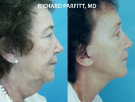 Procedure: Submental (Neck) Liposuction, Facelift, Blepharoplasty Middleton WI facial plastic surgery neck liposuction before and after